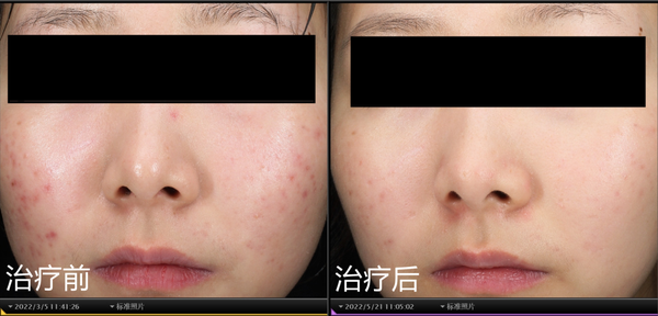 修复痘印痘坑最有效的方法（痘印痘坑如何修复小妙招）